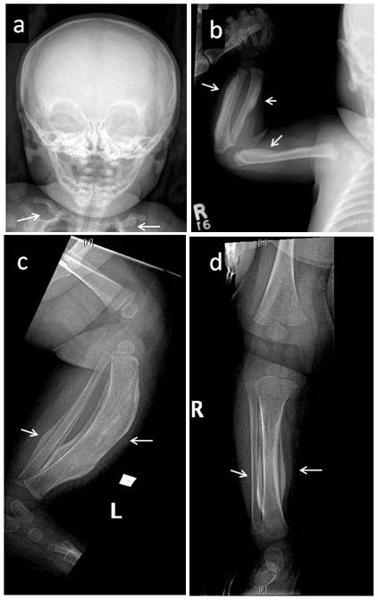 【佳学基因检测】卡菲病分子诊断怎么做Caffey Disease？