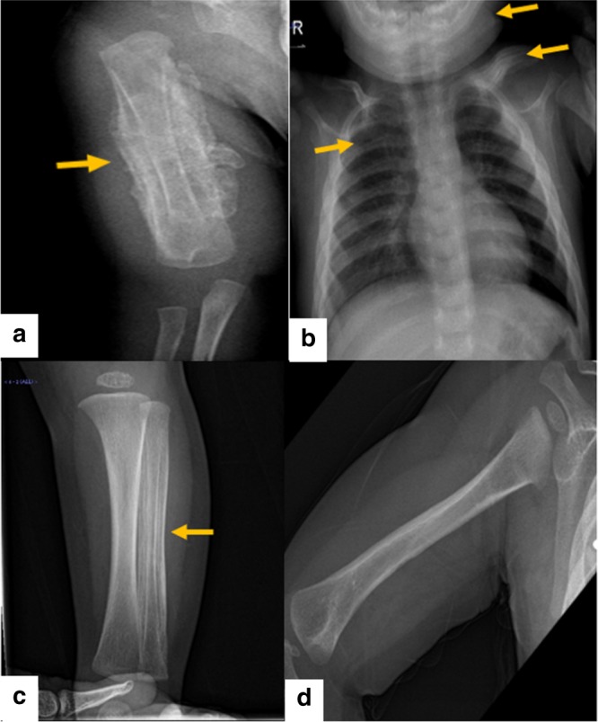 【佳学基因检测】德托尼-卡菲病基因解码、基因检测案例De Toni-Caffey disease
