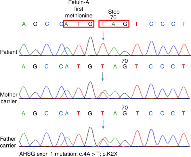 【佳学基因检测】德托尼-卡菲病基因解码、基因检测案例De Toni-Caffey disease