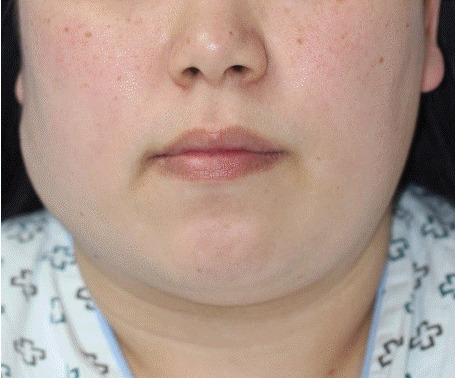 【佳学基因检测】巨大毛母质瘤的基因检测案例 【佳学基因检测】巨大毛母质瘤的基因检测案例