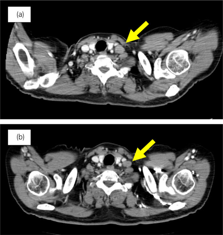 【佳学基因检测】靶向药物奥拉帕尼治疗具有BRCA突变的前列腺癌患者 【佳学基因检测】靶向药物奥拉帕尼治疗具有BRCA突变的前列腺癌患者