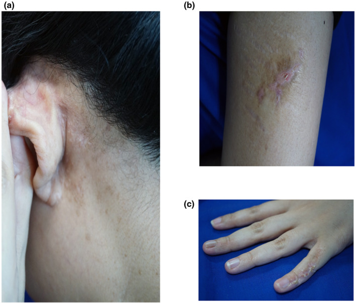 【佳学基因检测】CHILD综合征基因解码、基因检测有什么用? 【佳学基因检测】CHILD综合征基因解码、基因检测有什么用?
