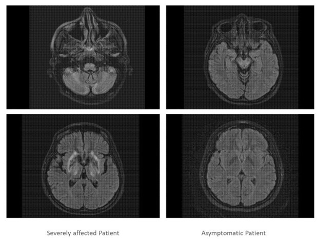 【佳学基因检测】基因检测纯合子双胞胎的临床表型变异性及对治疗法方案的差异性