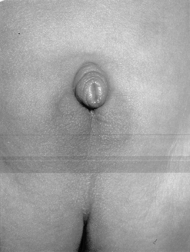 【性发育异常基因检测】假两性畸形怎么办？如何诊断和治疗？